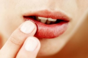 лечение сухости губ