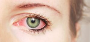 Покраснение белков глаз